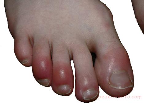 چيل بلين چیست