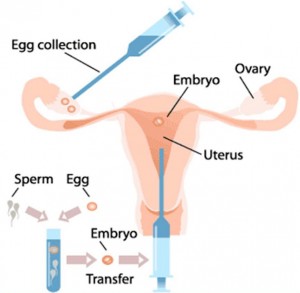 آی وی اف (IVF ) چیست