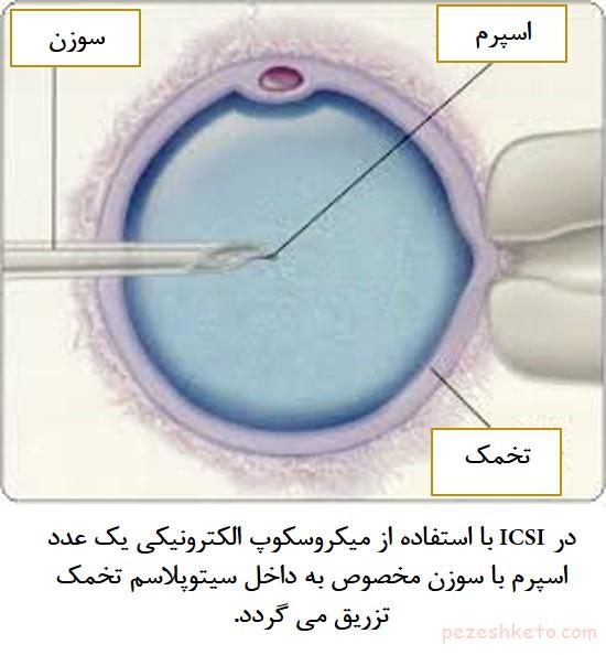 مقاله درباره میکرواینجکشن