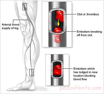 آمبولی‌ شریانی چیست