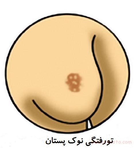 علل نامقارن بودن سینه در خانمها