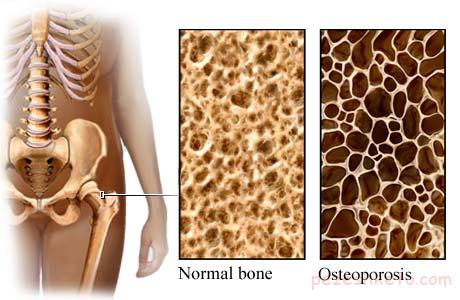 درمانهای پوکی استخوان