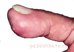 عفونت نوک انگشتان دست