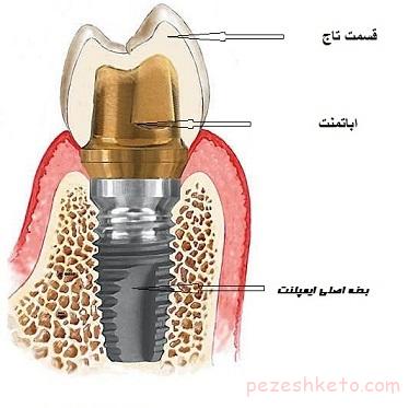 معرفی قسمت های مختلف ایمپلنت