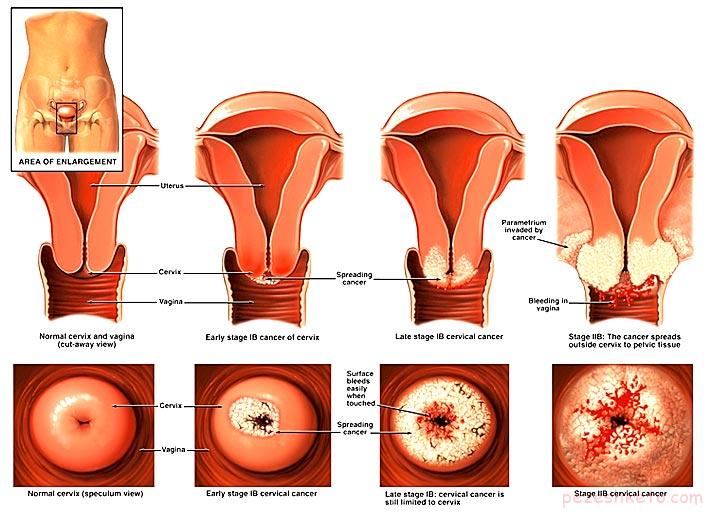 روشهای درمان سرطان واژن