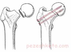 شکستگی استخوان ران
