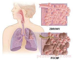 برونشکتازی یا نایژه فراخی چیست