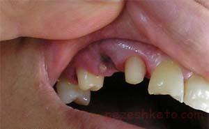 پروتز دندان