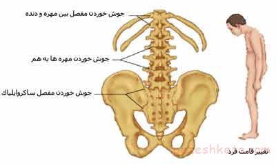 درمان بیماری اسپوندیلیت انکیلوزان چیست