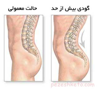 تمرین برای کاهش گودی کمر
