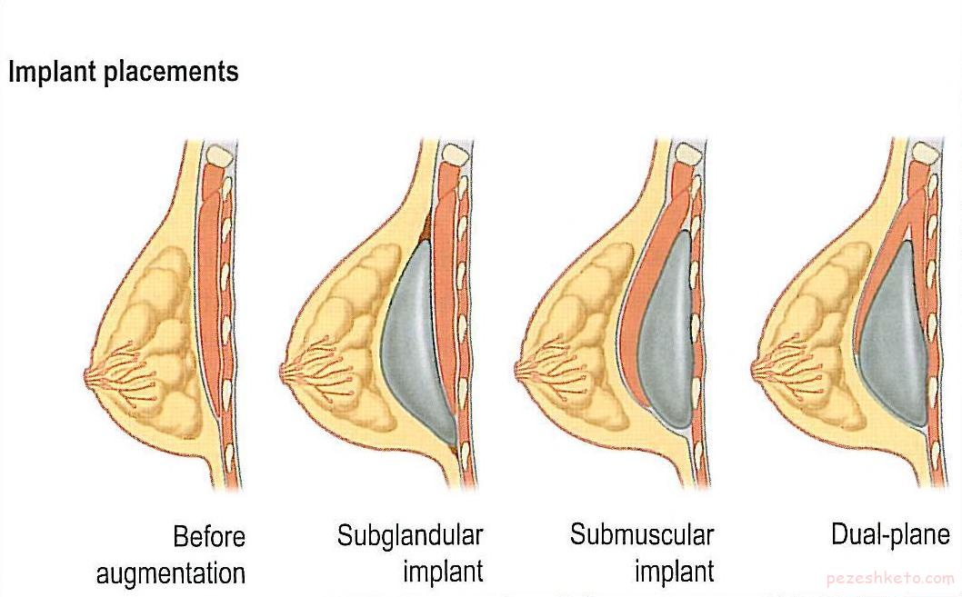 اطلاعات کامل درباره پروتز سینه
