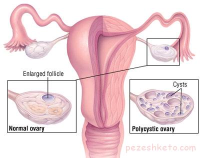 اثر چاقی بر سندرم تخمدان پلی کیستیک