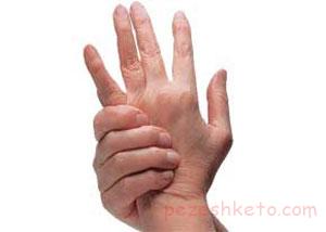 اسکلرودرما چیست