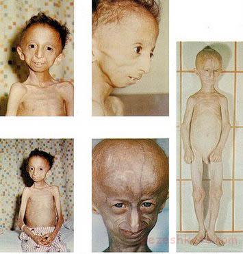 سندرم پروجریا چیست