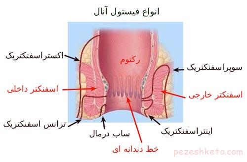 آبسه مقعد یا فیستول چیست