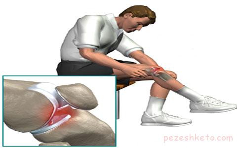 قفل شدن زانو