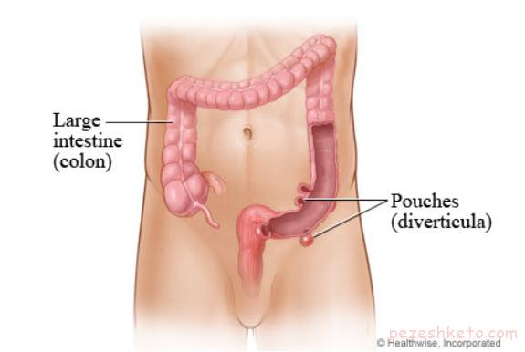 بیماری دیورتیکولیت روده بزرگ چیست