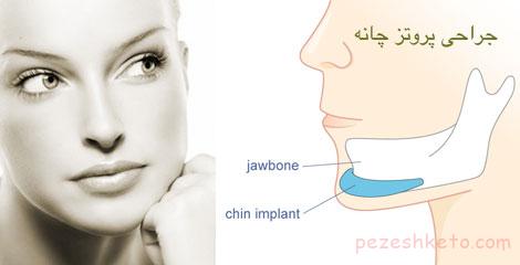 عمل جراحی زیبایی چانه