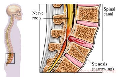 تنگی کانال نخاعی چیست