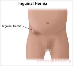 فتق مغبنی چیست