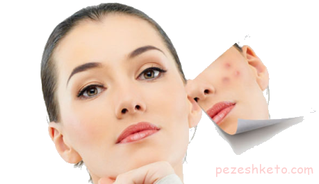 اطلاعاتی درباره انواع آکنه