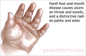 بیماری دست پا دهان