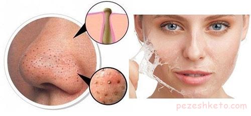 علل جوشهای زیر پوستی چیست