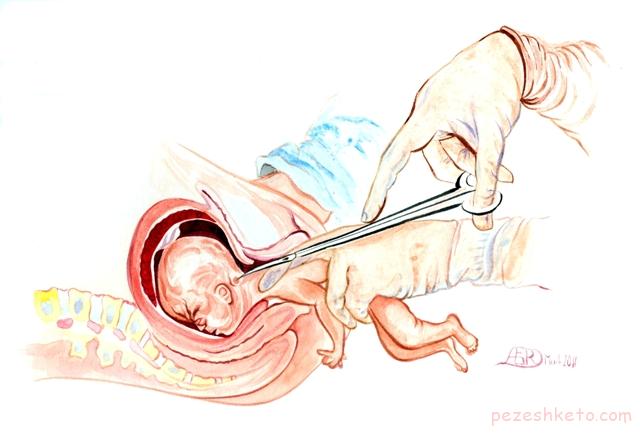 راههای قانونی سقط جنین در ایران