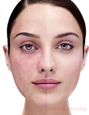 علل و درمان لکهای تیره پوست