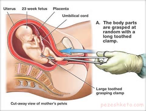 کورتاژ چیست