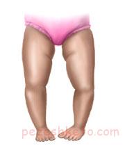 علائم نرمی استخوان