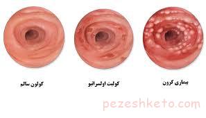 اطلاعاتی درباره بیماری کرون