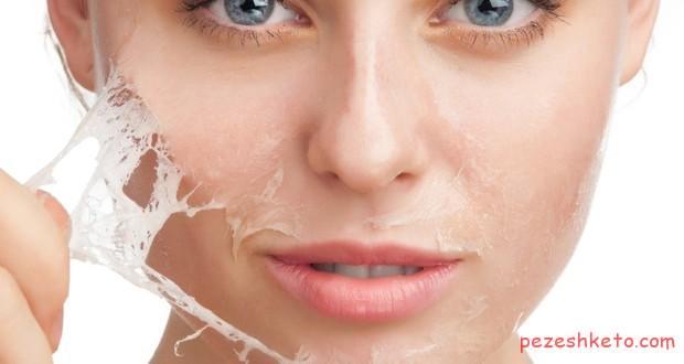 از بین بردن جای جوش