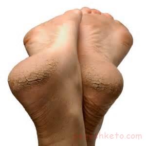 رفع ترک پا چگونه است