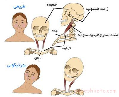تورتیکولی یا کجی گردن نوزاد تورتیکولی