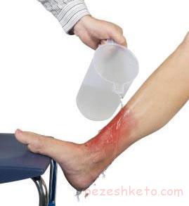 نکاتی درباره تاول سوختگیها