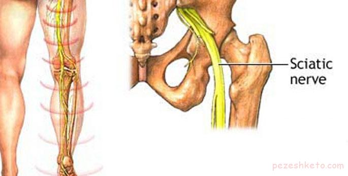 درد سیاتیک چیست