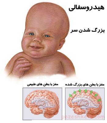 هیدروسفالی