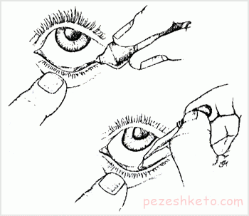 ورم ملتحمه یا كونژنكتیویت چیست