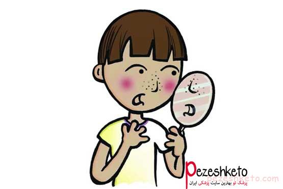 نکاتی برای افراد دارای جوش