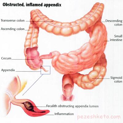 آپاندیسیت در کودکان