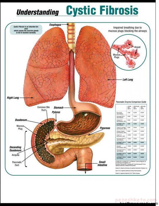بیماری فیبروز کیستی چیست