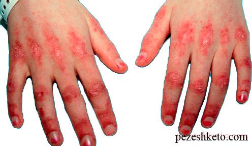 درماتوميوزيس