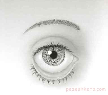 چرخیدن پلک به خارج چشم یا اکتروپیون