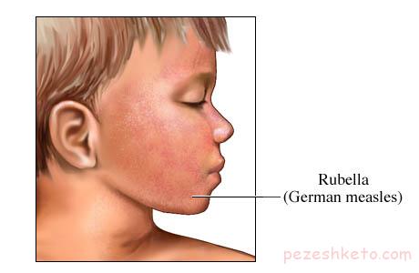 بیماری سرخجه یا روبلا چیست