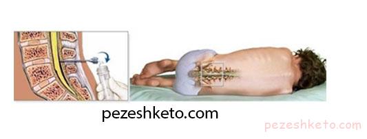 لومبار پانکچر چیست