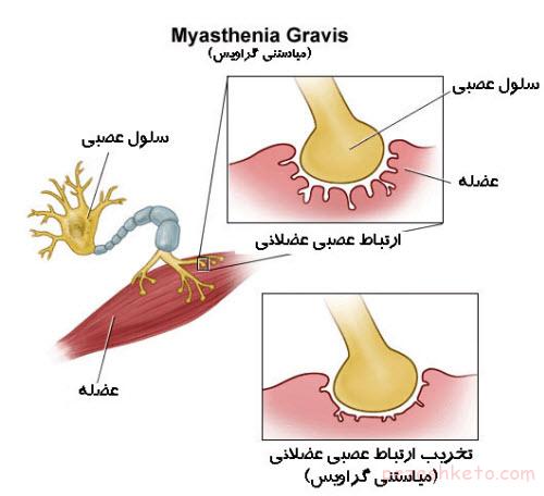 بیماری میاستنی گراو یا ضعف عضلانی