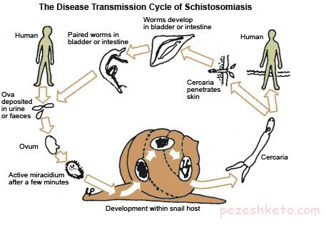 بیماری شیستوزومیاز