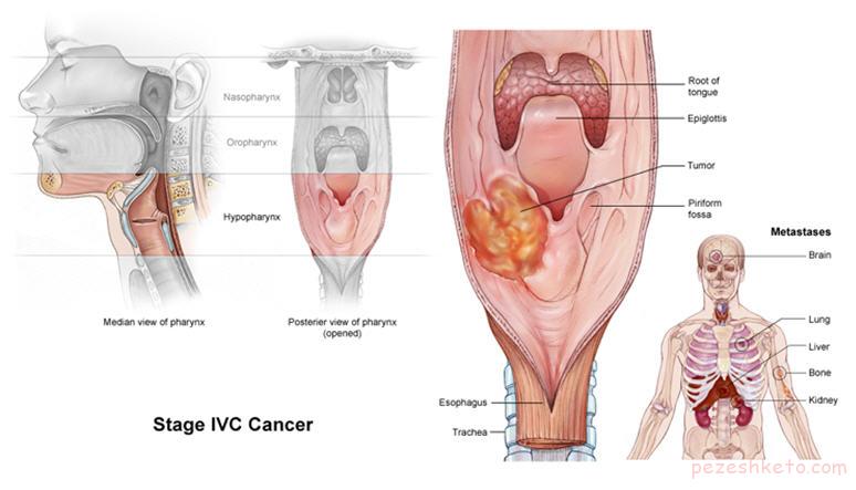اطلاعاتی درباره سرطان حنجره