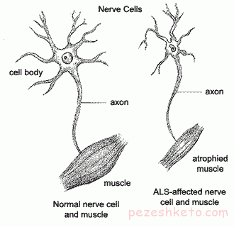 بیماری اسکلروز جانبی آمیوتروفیک